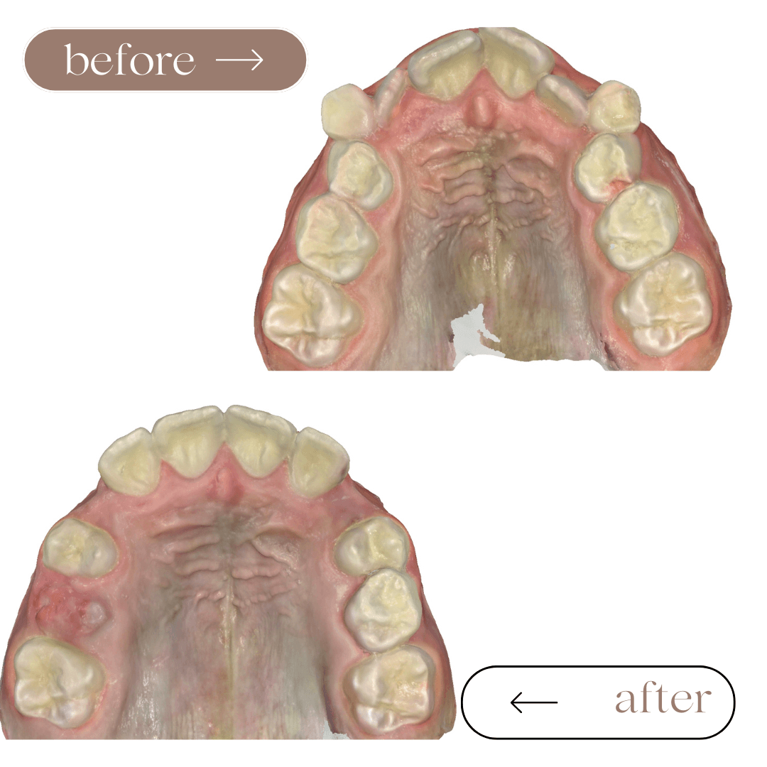What is the advantage of Phase 1 orthodontic treatment?