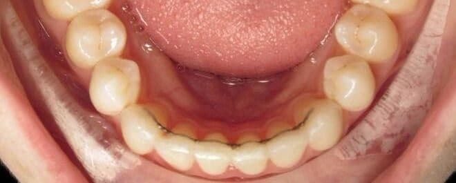 What happens if the glue comes off my permanent retainer?