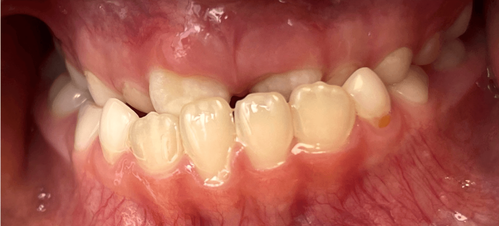 Underbite in kids: Why Timing Matters for Growing Smiles