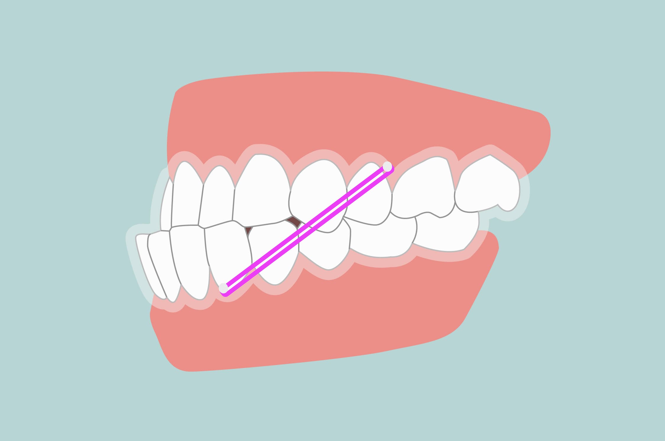 When to correct an under bite?