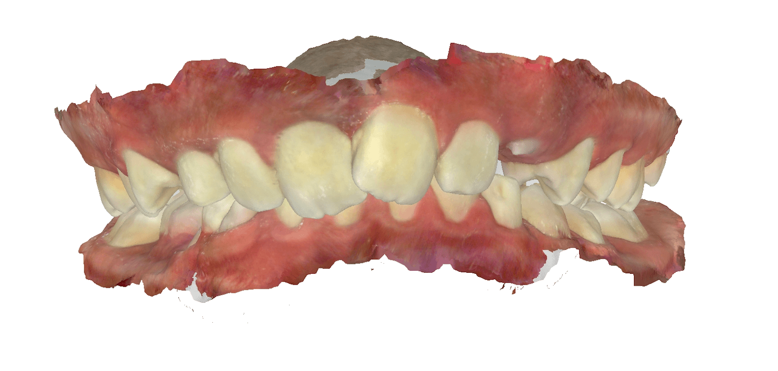 Understanding Deep Bites and the Importance of Orthodontics