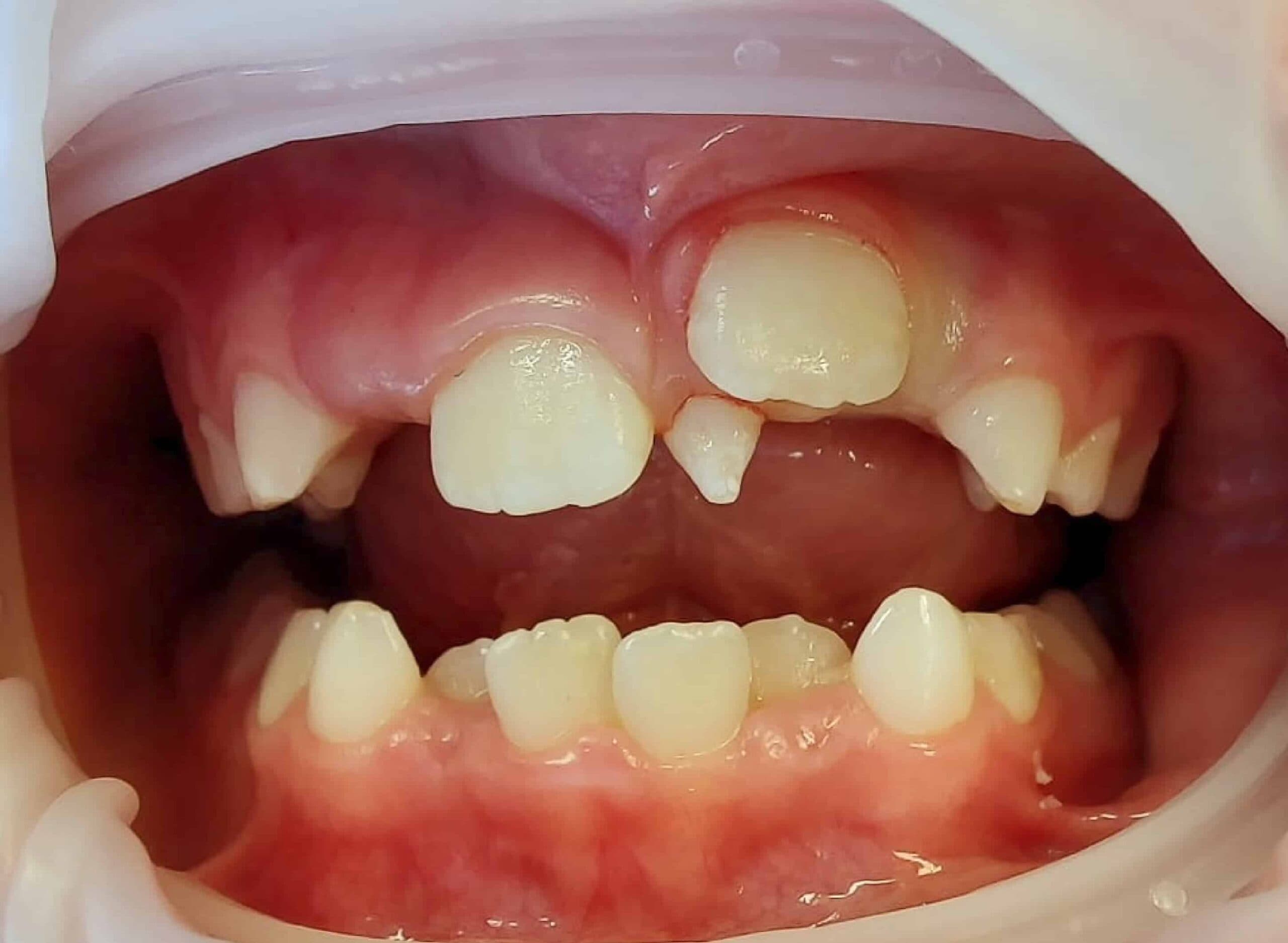Orthodontic Implications of Extra Teeth: What You Need to Know