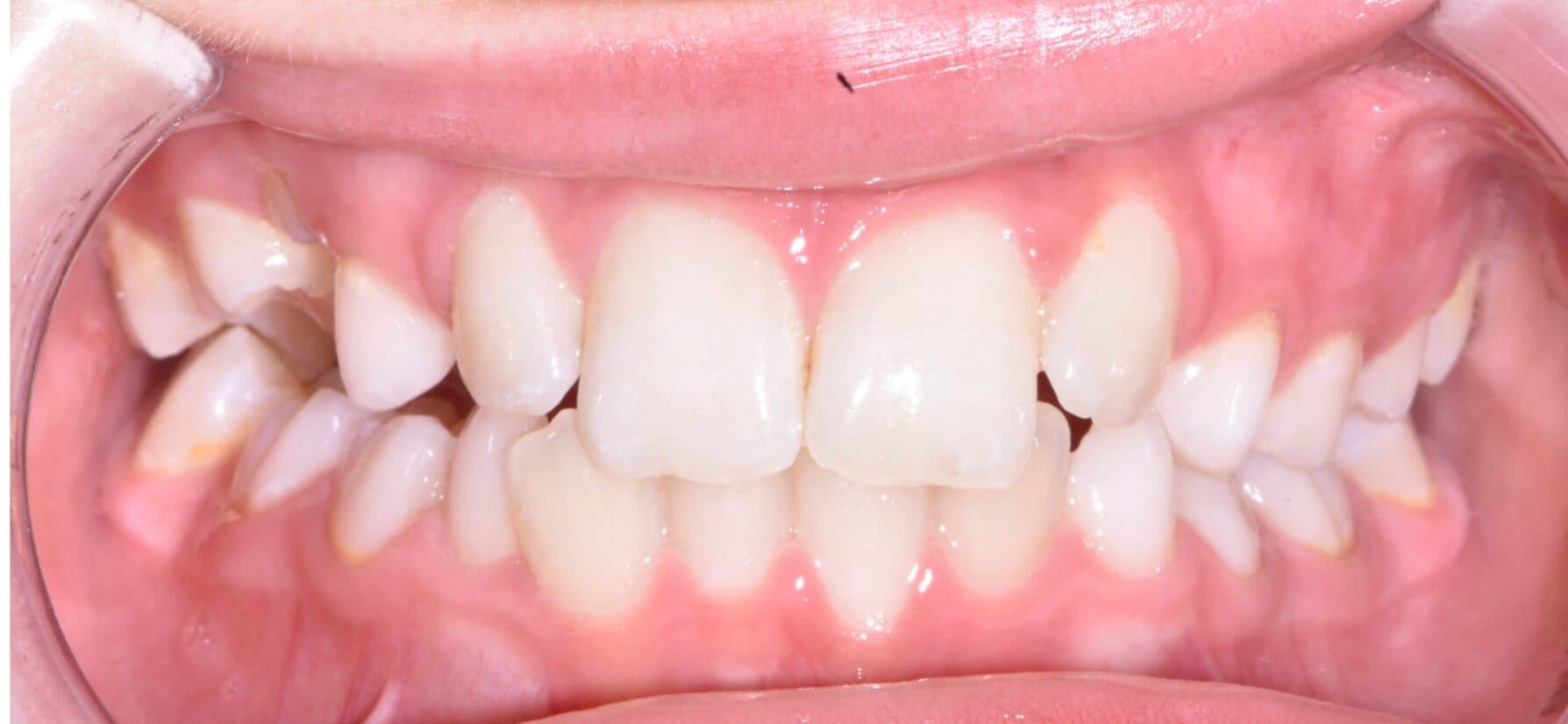 Baby Tooth Ankylosis: Why Early Orthodontic Assessment is Essential