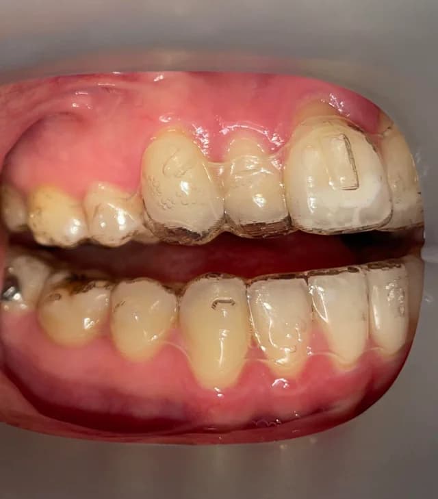 What is the small gap in my aligners?