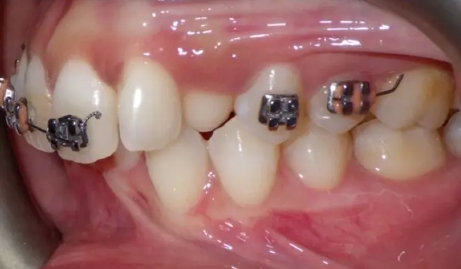 Broken braces bracket and wire