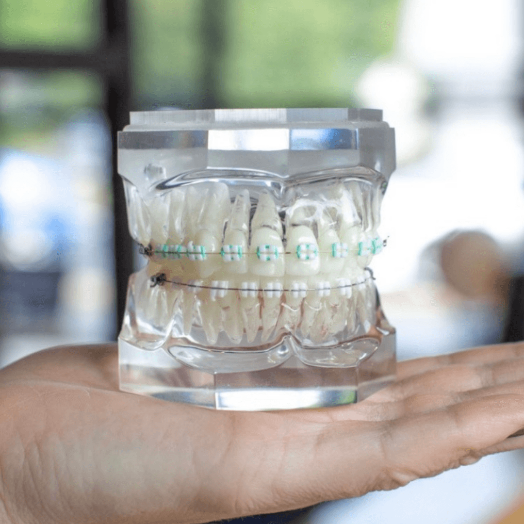 How do braces know where to move teeth?