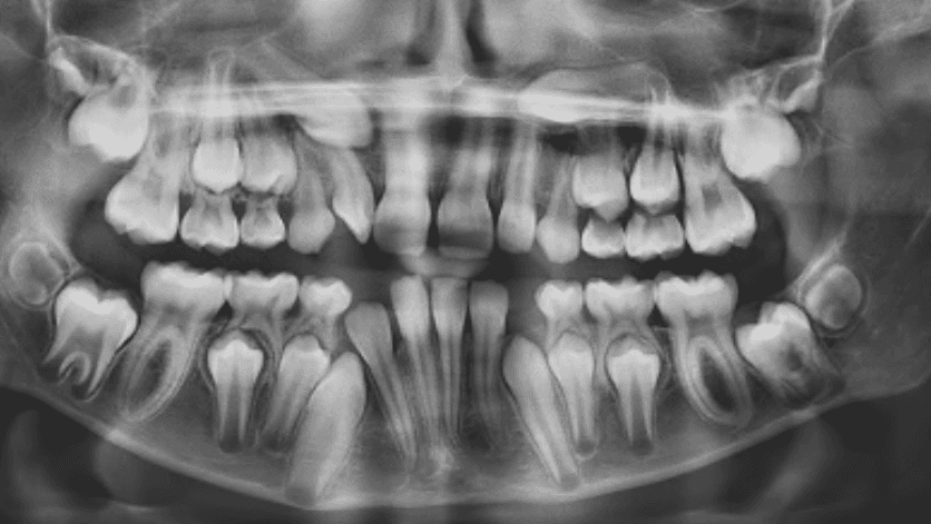 Impacted Canine Teeth: How to Tell If You Have One and What to Do?