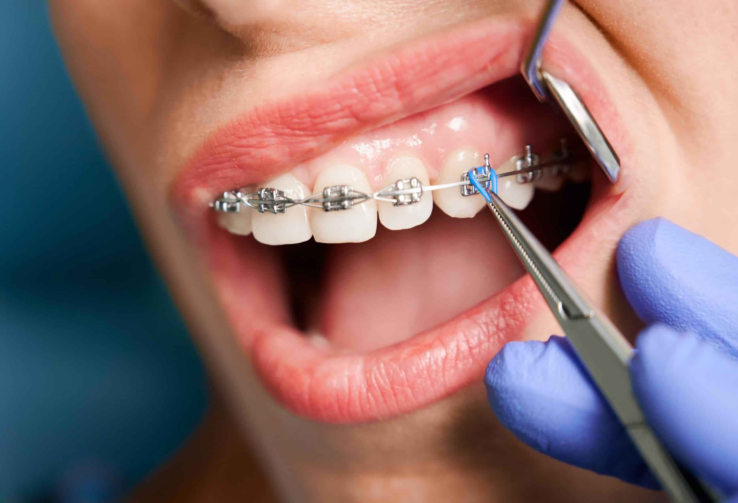 Why braces adjustment appointments are important