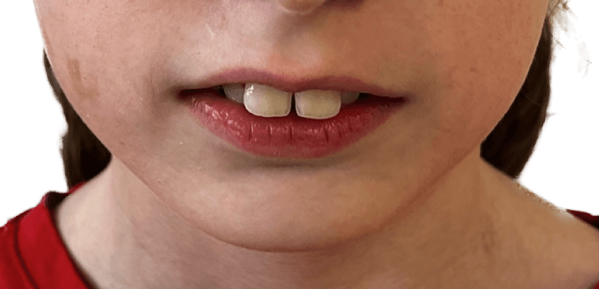 When Is the Best Time to Treat an Overbite (Overjet)?