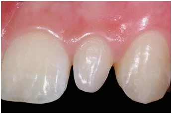 Orthodontic Treatment for Peg-Shaped Lateral Incisors: A Comprehensive Guide
