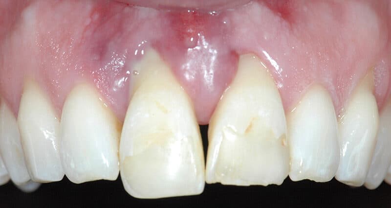 Why is my one tooth now longer than the rest?
