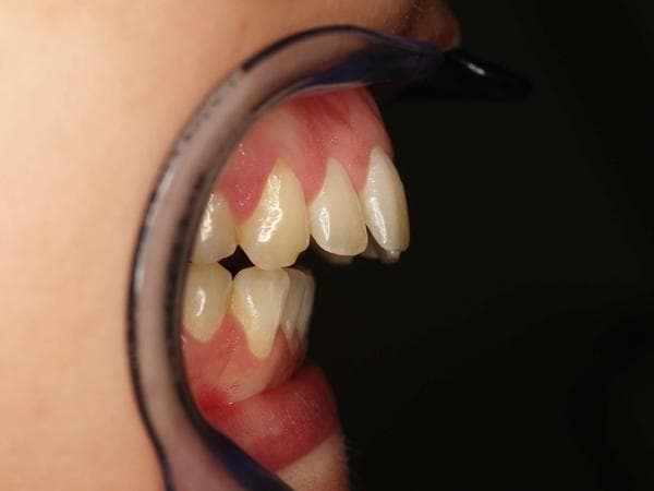 What is dental protrusion and how to fix it?