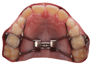 Rapid Palatal Expander