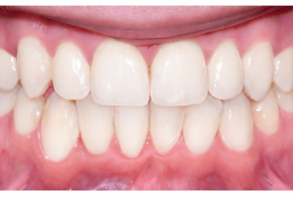 Smile Transformation at Broadbeach Orthodontics