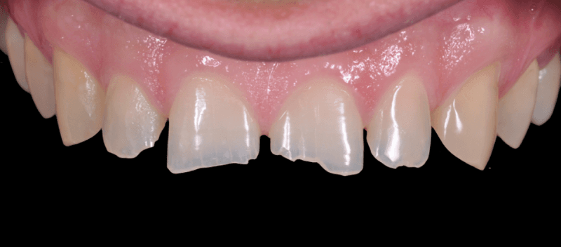 How to avoid teeth wear?