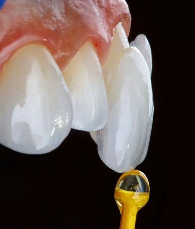 Why You Should Get an Orthodontic opinion Before Getting Veneers?