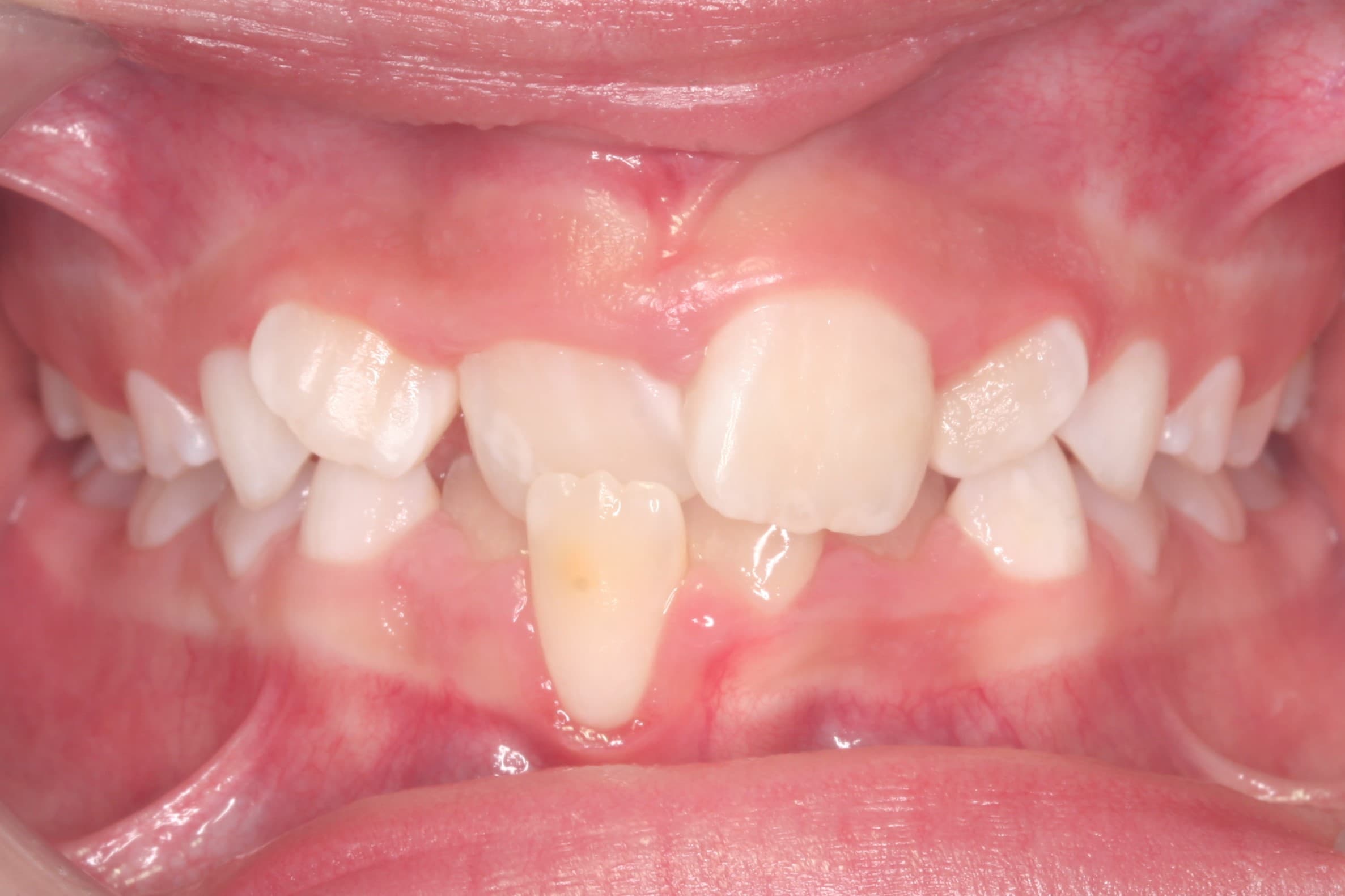 What is an Anterior Cross-bite and the Importance of Early correction