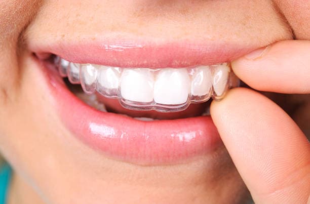 Dealing with Tight Retainers