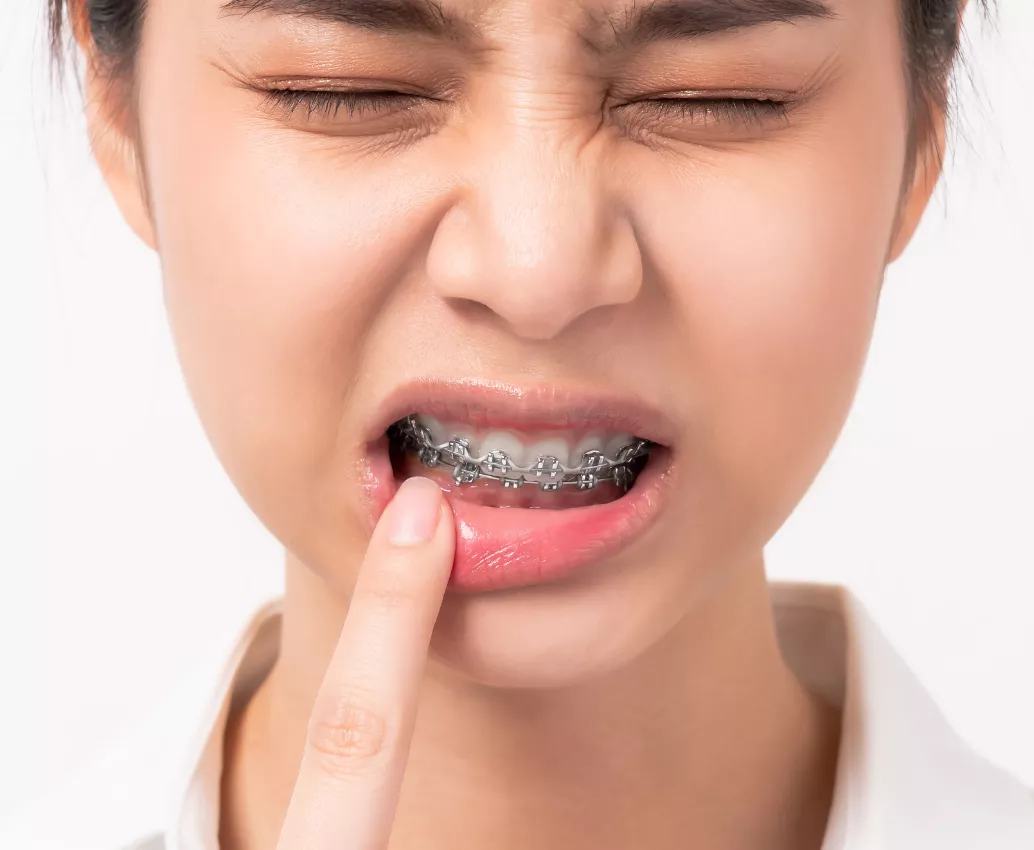 How to manage ulcers from braces