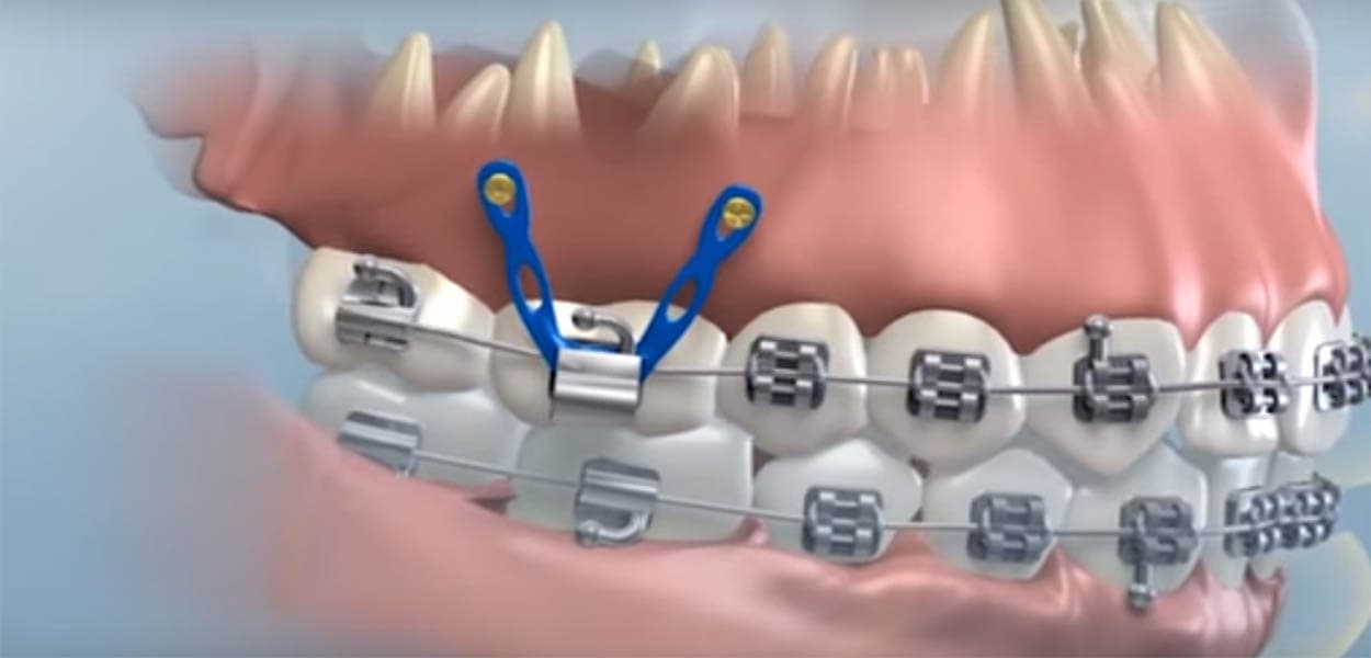What Are TADs in Orthodontics? Everything You Need to Know