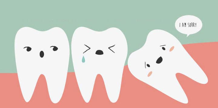 Wisdom Teeth Removal: What You Need to Know