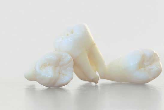 Wisdom Teeth Removal After Braces: What You Need to Know