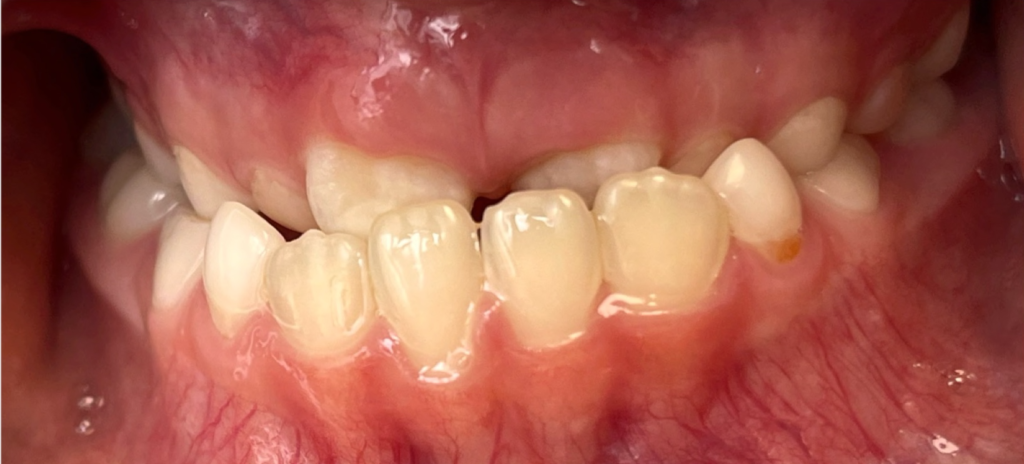 Class 3 - underbite