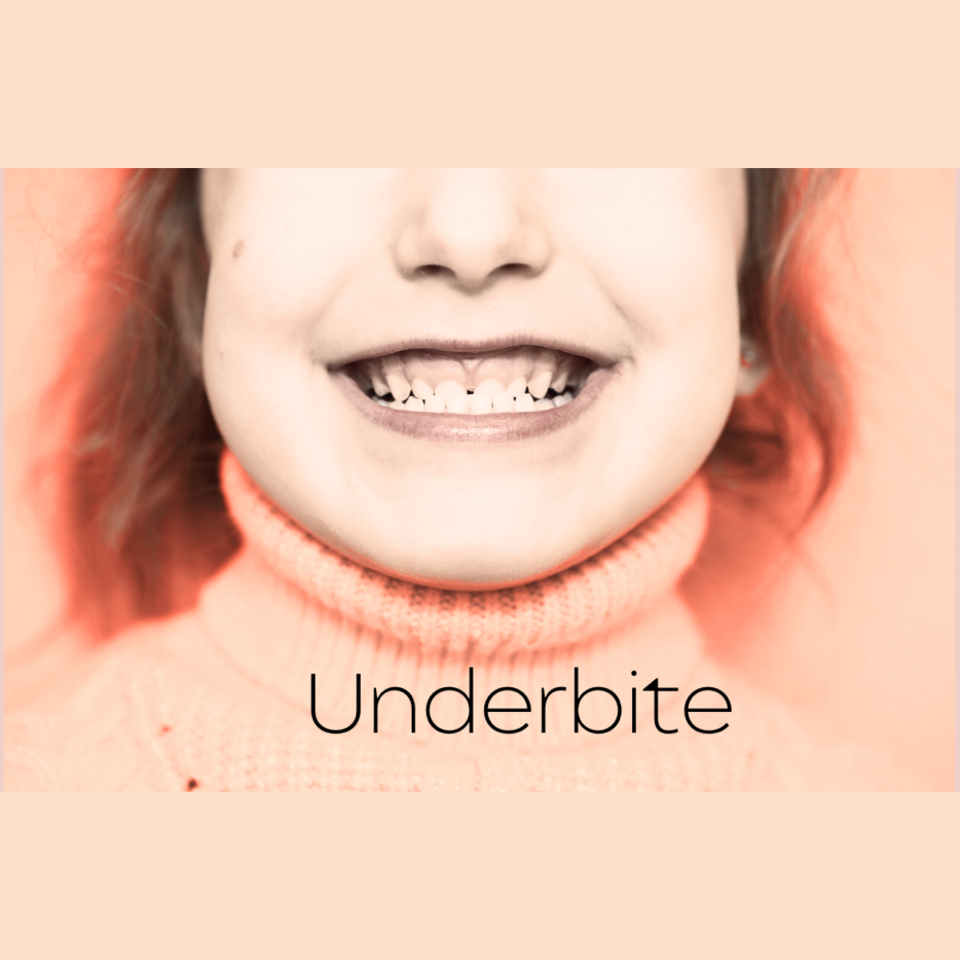 Underbites